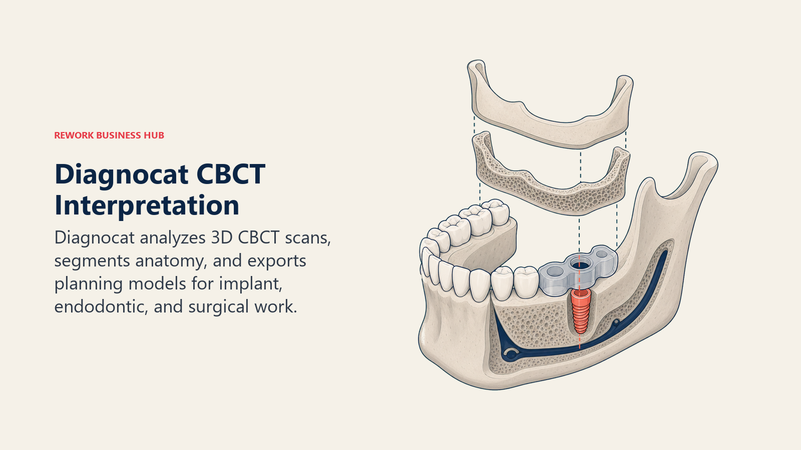 Diagnocat CBCT interpretation shown as a segmented 3D jaw model prepared for implant and surgical planning