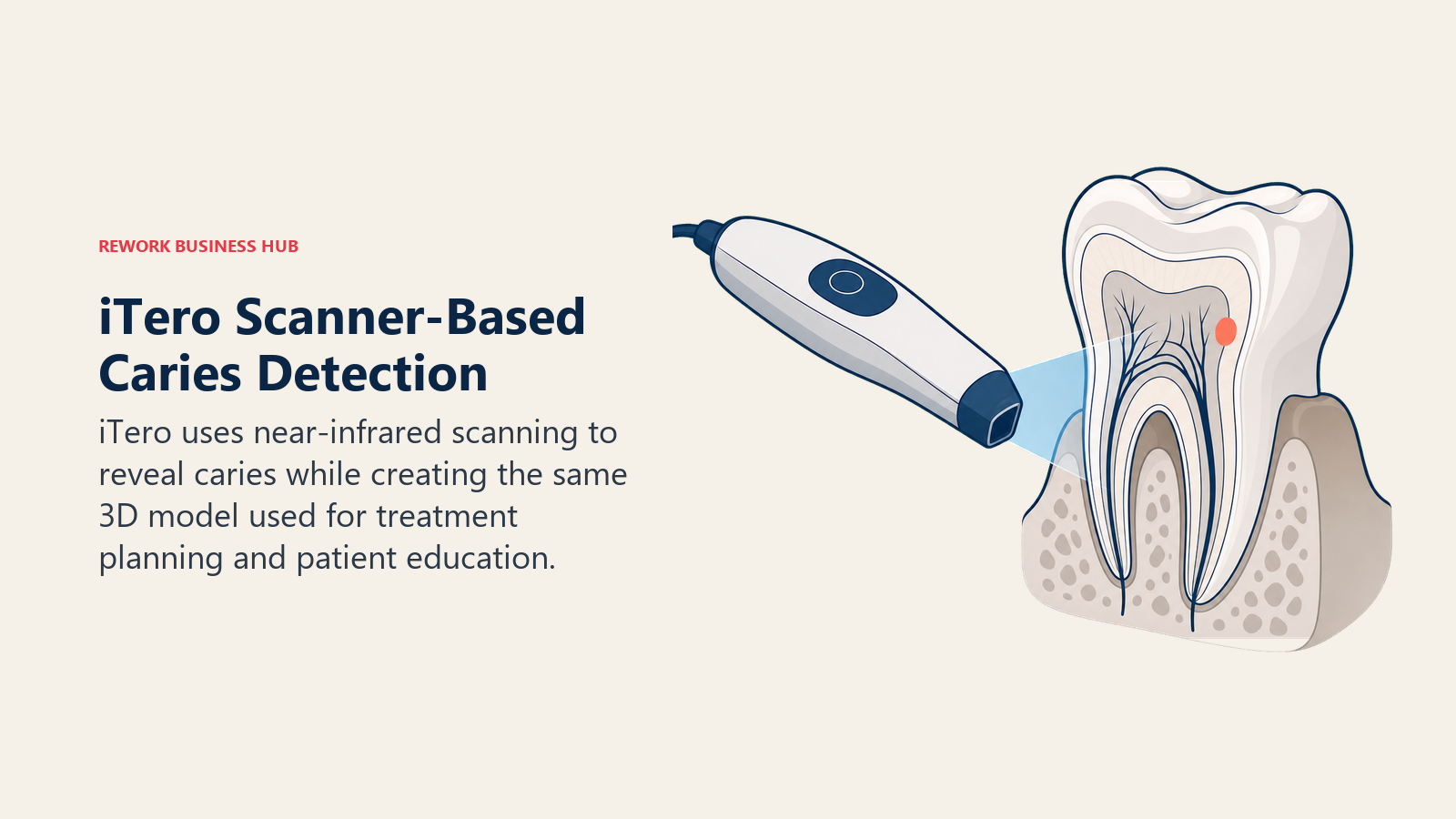 iTero scanner-based caries detection using near-infrared imaging to reveal a lesion inside a 3D tooth model